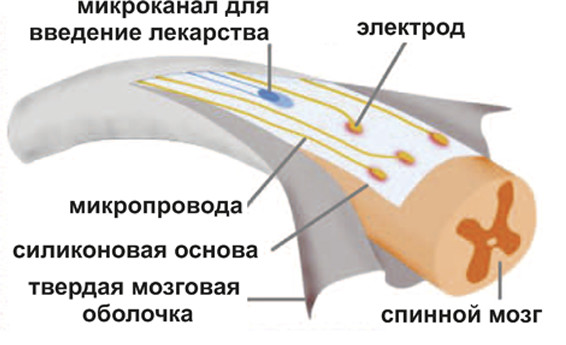 Мягкие имплантанты Мягкие имплантанты